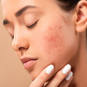 Acne Relief Treatment in New York