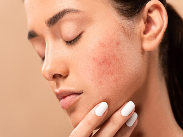 Acne Relief Treatment in New York