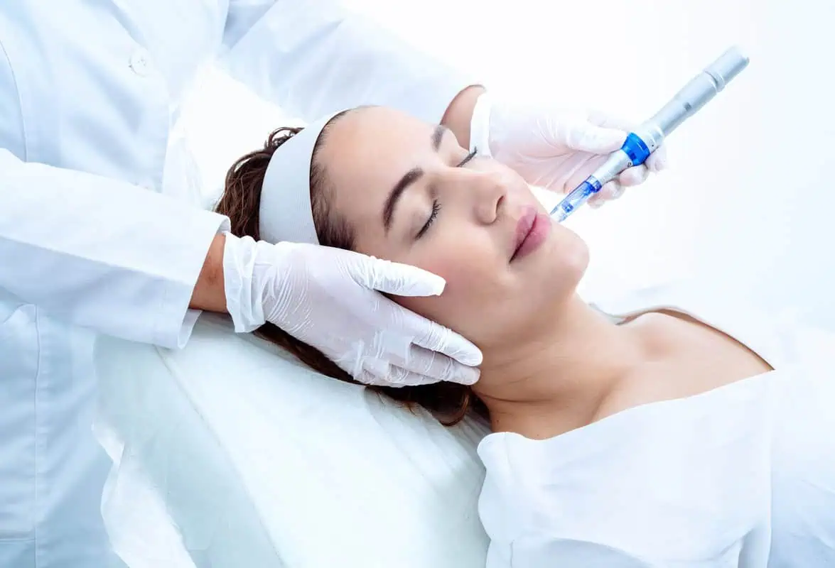 Microneedling Treatment