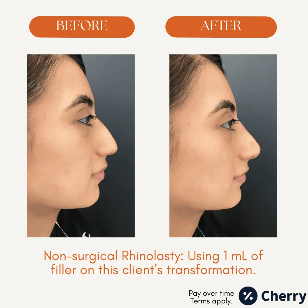 Liquid Rhinoplasty ba