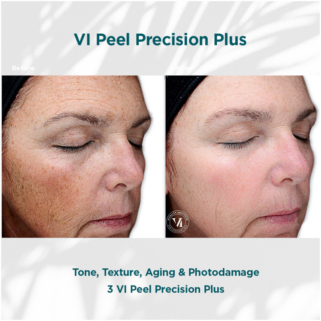 VI Peel - before and after 3