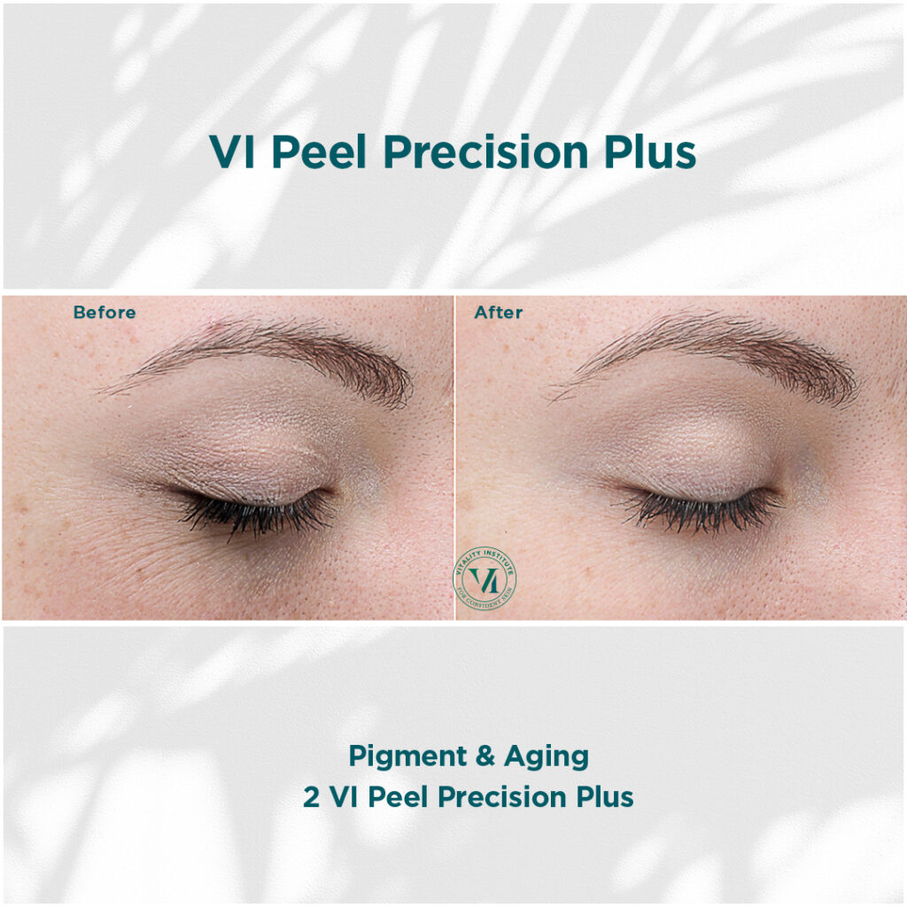 Vi Peel - before and after 2