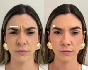 Neurotoxins Before & After