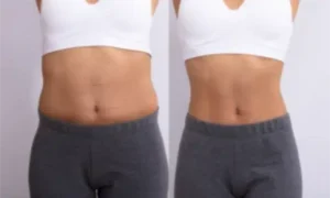 before and after glp weight loss treatment at casaglow medspa