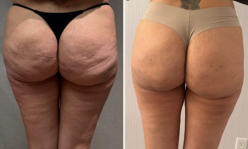 Cellulite Treatment in nyc