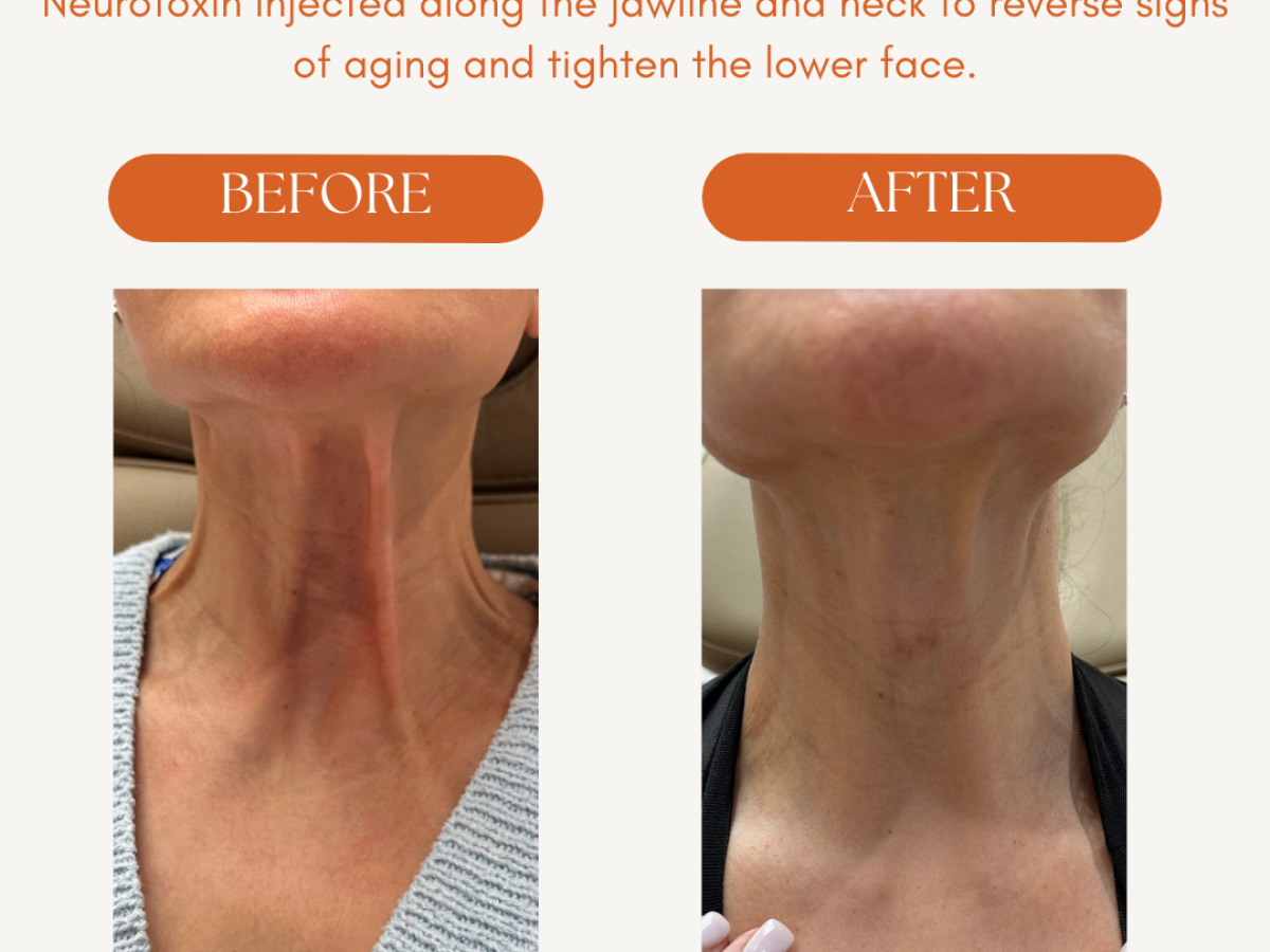 Neck Treatment in nyc